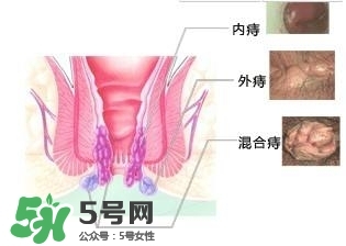 痔瘡吃什么藥效果好？痔瘡吃什么藥好得快？