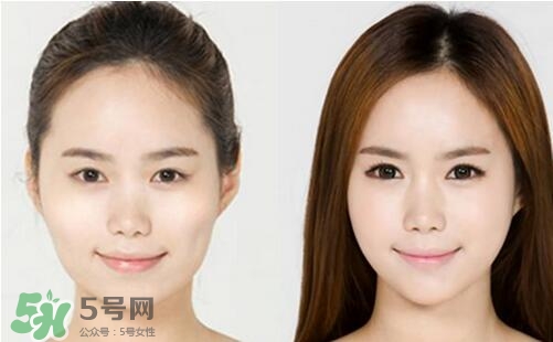 瘦臉針分為幾種類型？瘦臉針有哪幾個牌子？
