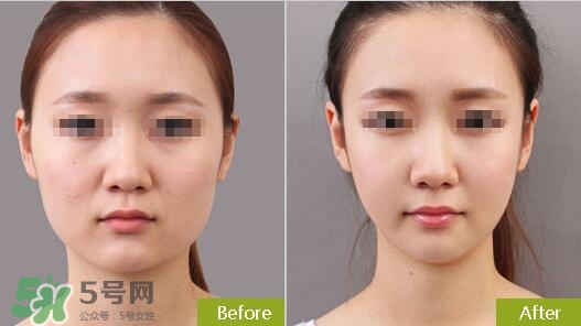 瘦臉針分為幾種類型？瘦臉針有哪幾個牌子？