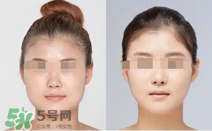 瘦臉針分為幾種類型？瘦臉針有哪幾個牌子？