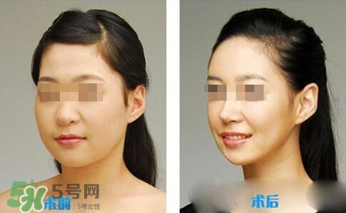 瘦臉針分為幾種類型？瘦臉針有哪幾個牌子？
