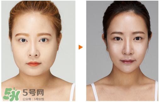 瘦臉針分為幾種類型？瘦臉針有哪幾個牌子？