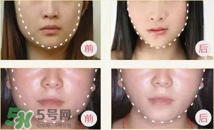 打完瘦臉針多久可以化妝？打完瘦臉針的反應(yīng)