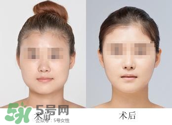 打瘦臉針能喝酒嗎？打瘦臉針能吃海鮮嗎？