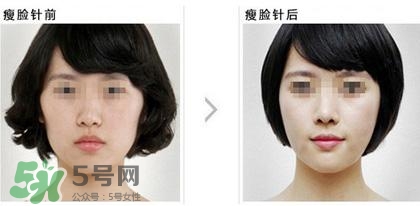 打瘦臉針能喝酒嗎？打瘦臉針能吃海鮮嗎？