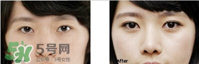 開(kāi)眼角要恢復(fù)多久？開(kāi)眼角好不好？