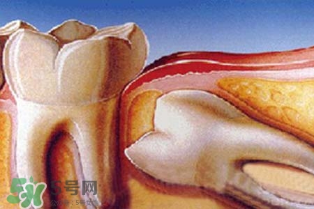 智齒經(jīng)常發(fā)炎怎么辦？智齒反復(fù)發(fā)炎腫痛怎么辦？