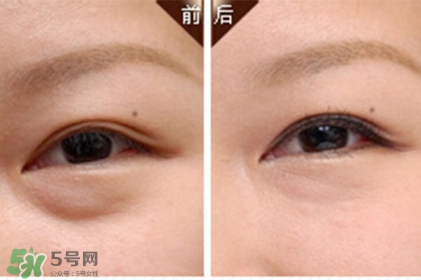 臥蠶是黑眼圈嗎？臥蠶和黑眼圈的區(qū)別