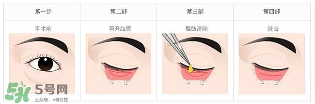 眼袋是怎么形成的？手術(shù)去眼袋安全嗎