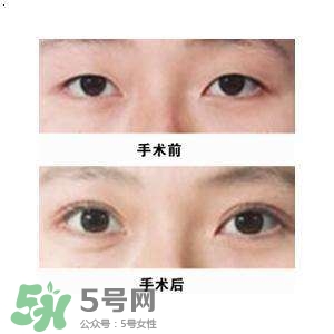 割雙眼皮疼不疼？割雙眼皮疼幾天能好？