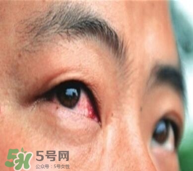 紅眼病是怎么引起的？紅眼病怎么產(chǎn)生的