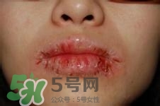 嘴唇干燥是什么原因？嘴唇干裂脫皮怎么辦？