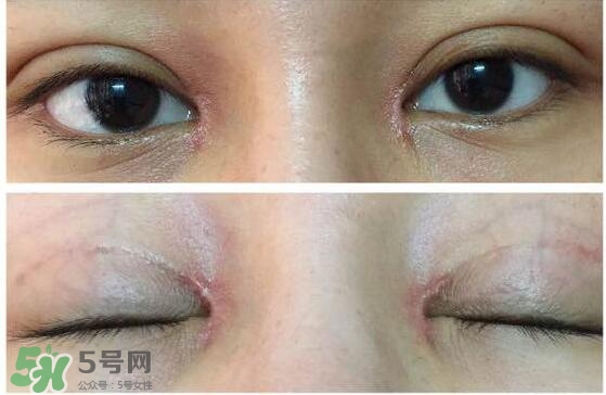 眼角增生是什么意思？眼角增生了怎么辦？