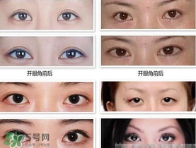 哪些人需要開(kāi)眼角？需要開(kāi)眼角的眼睛圖片