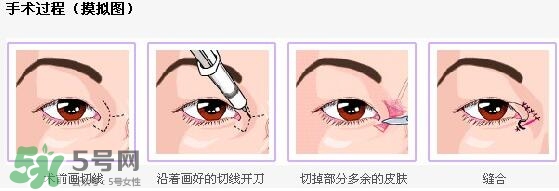 哪些人需要開(kāi)眼角？需要開(kāi)眼角的眼睛圖片