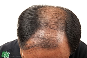 脫發(fā)怎么修復(fù) 脫發(fā)嚴重的原因是什么