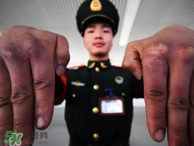 三月份還長凍瘡嗎？三月份凍瘡沒好怎么辦？