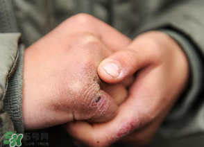 三月份還長凍瘡嗎？三月份凍瘡沒好怎么辦？