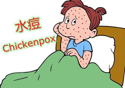 水痘是天花嗎？水痘是不是天花？