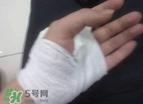 傷口化膿怎么處理？傷口化膿用什么藥好？