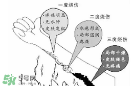 燙傷起泡要挑破嗎？燙傷起泡怎么處理？