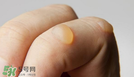 燙傷起泡要挑破嗎？燙傷起泡怎么處理？