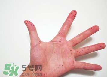 切辣椒后手很辣怎么辦？切辣椒后手很辣多久能好