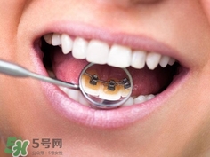 補(bǔ)牙洞需要幾次完成?補(bǔ)牙洞需要多長時間?