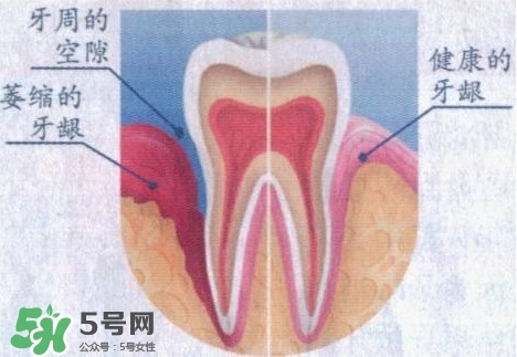 牙齦萎縮怎么辦？牙齦萎縮癥狀