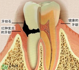 牙結(jié)石是什么？牙結(jié)石圖片