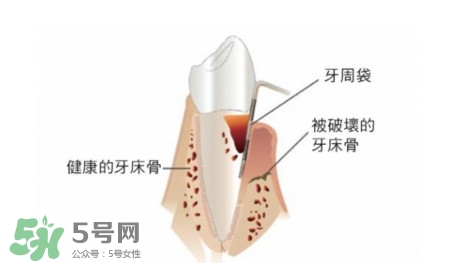 牙周炎怎么治療？牙周炎怎么治好