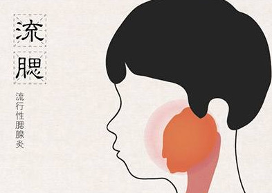 流行性腮腺炎有哪些癥狀？流行性腮腺炎的癥狀