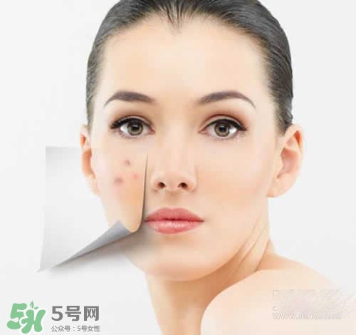 黑色痘印多久會消失？黑色痘印消失時(shí)間