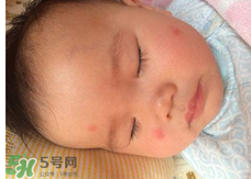 嬰兒蚊子咬了怎么消腫？嬰兒蚊子咬了怎么消腫止癢最快？
