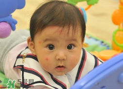 嬰兒被蚊子咬了如何去紅點(diǎn)？被蚊子咬后紅點(diǎn)如何去除？