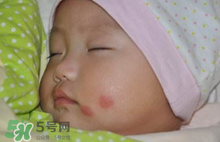 嬰兒被蚊子咬了如何去紅點(diǎn)？被蚊子咬后紅點(diǎn)如何去除？