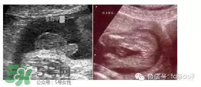B超單數(shù)據(jù)怎么看男女？B超單看男女準(zhǔn)嗎？