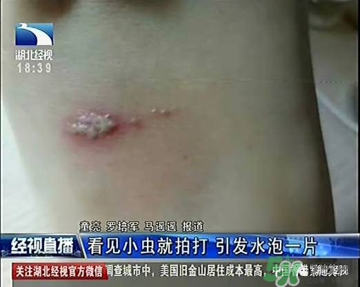 隱翅蟲有毒嗎？隱翅蟲會(huì)毀容嗎？