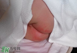 尿布疹怎么辦？寶寶尿布疹擦什么藥好？