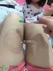 日本msd祛疤膏怎么樣？日本msd祛疤膏有用嗎？
