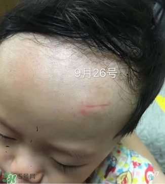 日本msd祛疤膏是抗生素嗎？日本msd祛疤膏是不是抗生素？