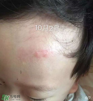 日本msd祛疤膏是抗生素嗎？日本msd祛疤膏是不是抗生素？