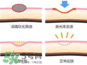 藥水點(diǎn)痣和激光點(diǎn)痣哪個(gè)好？各有什么優(yōu)缺點(diǎn)
