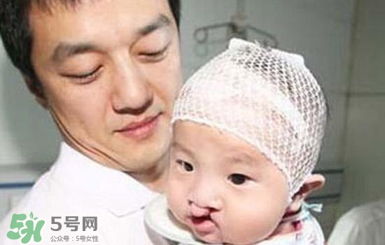 兔唇是什么？兔唇是什么原因造成的？