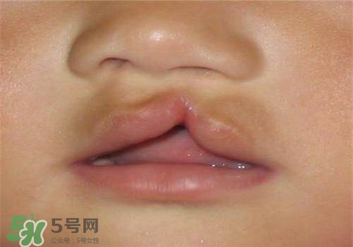 兔唇能檢查出來(lái)嗎？兔唇能完全修復(fù)嗎？