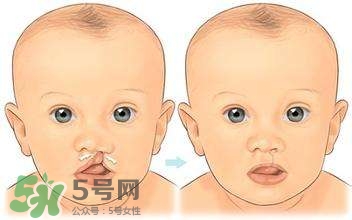 兔唇能檢查出來(lái)嗎？兔唇能完全修復(fù)嗎？