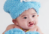 兔唇可以治嗎？兔唇修補術