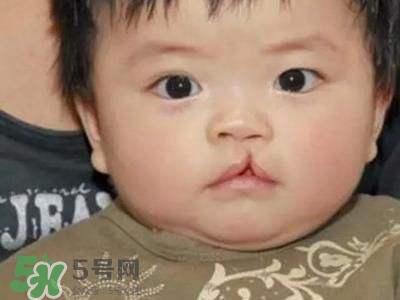 兔唇可以治嗎？兔唇修補術