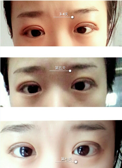 三點(diǎn)定位雙眼皮永久嗎 三點(diǎn)定位雙眼皮恢復(fù)過(guò)程圖片