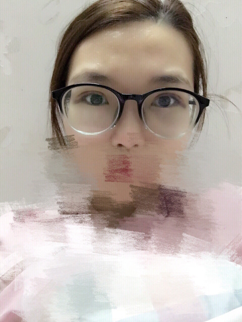 三點(diǎn)定位雙眼皮永久嗎 三點(diǎn)定位雙眼皮恢復(fù)過(guò)程圖片